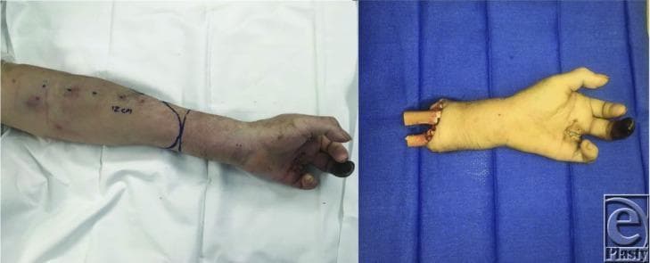 A side-by-side clinical photograph documenting surgical planning for a major upper limb amputation and the resulting specimen. The left panel shows the patient's distal forearm and hand prior to surgery. A 'fish mouth' incision line is marked in surgical ink at the mid-distal forearm, accompanied by a '12 cm' measurement. Multiple small circular markings and areas of skin mottling/discoloration are visible on the forearm, suggesting compromised vascularity. The left ring finger demonstrates clear dry gangrene with black, necrotic tissue. The right panel displays the amputated distal hand segment positioned on a blue sterile field. The specimen shows the exposed radius and ulna at the proximal resection margin. The palmar surface of the hand reveals non-healing surgical wounds and sutures at the base of the fingers, particularly near the gangrenous ring finger. This visual illustrates surgical level selection and planning in the context of peripheral vascular disease and diabetic limb complications.