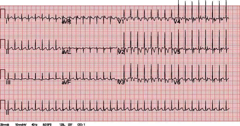 A standard 12-lead electrocardiogram (ECG) printed on grid paper, displaying a narrow-complex tachycardia consistent with paroxysmal supraventricular tachycardia (PSVT). The tracing shows a rapid ventricular rate exceeding 200 beats per minute with highly regular R-R intervals. P waves are not clearly discernible, as they are likely buried within or superimposed upon the preceding T waves due to the extreme tachycardia. The QRS complexes remain narrow (<120ms), indicating a supraventricular origin of the rhythm. In the precordial leads (V1-V6), there is a normal, progressive R-wave progression from V1 through V6. No significant ST-segment elevation, depression, or pathological Q waves are immediately evident at this rate. This diagnostic image illustrates the classic presentation of a tachyarrhythmia where the high heart rate obscures normal atrial activity, requiring clinical correlation and potentially vagal maneuvers or pharmacological intervention (e.g., adenosine) for definitive rhythm identification and termination.