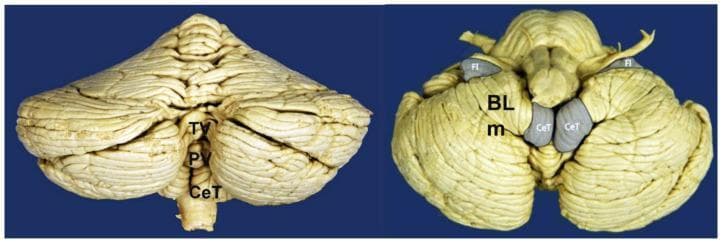 This medical anatomical diagram features two clinical photographs of a gross human cerebellum and brainstem specimen, highlighting key surface anatomy. The left image provides a posterior view, emphasizing the midline vermis and cerebellar hemispheres. Labeled structures include the tuber of vermis (TV) superiorly, the pyramid of vermis (PV) centrally, and the cerebellar tonsils (CeT) at the inferior margin. The right image presents an inferior view, showcasing the ventral aspects and the relationship to the brainstem. Key labels include the flocculus (Fl) positioned laterally, the medial part of the biventral lobe (BLm), and the cerebellar tonsils (CeT) adjacent to the midline. The visual illustrates the striated folia and lobular organization critical for understanding neuroanatomical relationships, particularly in the context of Chiari malformations and tonsillar herniation. This material is designed for intermediate to advanced medical education in neuroanatomy and neurology.