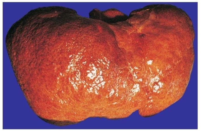 This clinical photograph displays a macroscopic view of a human liver specimen exhibiting advanced alcoholic cirrhosis. The organ demonstrates a characteristic micronodular surface, where the normally smooth capsule is replaced by a diffuse, granular texture. These numerous small, rounded protrusions represent regenerative nodules of hepatocytes surrounded by dense fibrotic septa. The liver color is predominantly reddish-brown with yellowish-tan areas, likely reflecting steatosis (fatty change) and variation in tissue density. Bright, fragmented light reflexes on the surface highlight the irregular, cobweb-like topography and uneven capsule tension typical of end-stage chronic liver disease. The specimen illustrates the pathological progression from chronic alcohol-induced injury to extensive fibrosis and architectural distortion, which are key diagnostic features of cirrhosis in hepatology and pathology education.