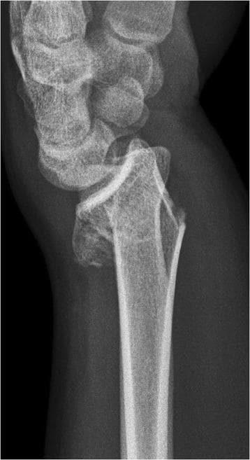 A lateral view diagnostic X-ray of the wrist demonstrating an unstable distal radius fracture, characteristic of a Colles-type injury. The radiograph reveals an oblique fracture line through the distal radial metaphysis with significant dorsal displacement and dorsal angulation of the distal fragment. Visible metaphyseal impaction and comminution are present on the dorsal aspect, creating a bone void or compression defect. This displacement results in secondary incongruity of the radiocarpal joint, as the carpal bones (including the scaphoid and lunate) remain aligned with the dorsally tilted distal radius fragment rather than the radial shaft. The image serves as a clinical example of metaphyseal instability requiring surgical intervention, such as volar locking plate fixation, to restore anatomical alignment and articular surface congruity.