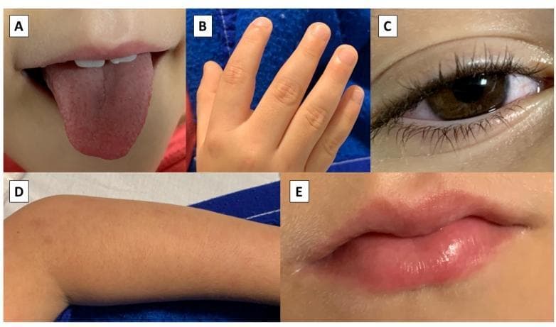 A composite of five clinical photographs (labeled A-E) illustrating the diagnostic features of Multisystem Inflammatory Syndrome in Children (MIS-C) and Kawasaki-like disease. Panel A shows a 'strawberry tongue' with prominent, inflamed papillae and diffuse erythema. Panel B demonstrates edema of the digits on the hand, characterized by swelling and loss of normal skin creases. Panel C displays bilateral bulbar conjunctival injection, notably sparing the limbus and presenting without exudate. Panel D shows a diffuse maculopapular cutaneous rash on the extremity. Panel E highlights oral mucositis, specifically erythematous, swollen, and cracked (fissured) lips. These visual markers are critical for the clinical identification of systemic inflammatory responses in pediatric patients, particularly those temporally associated with COVID-19 infection.
