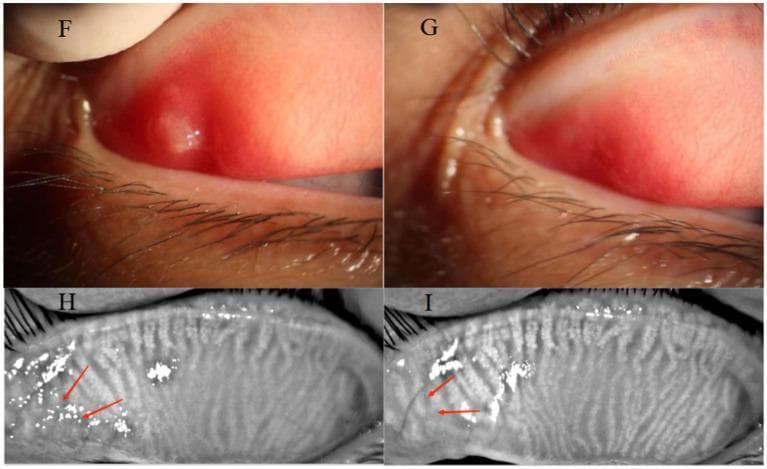 A multi-panel medical comparison showing a 32-year-old female patient with an upper eyelid chalazion before and after Optimal Pulse Technology (OPT) treatment. Panels F and G are clinical photographs of the everted upper palpebral conjunctiva. Panel F (baseline) demonstrates a raised, circumscribed chalazion with significant surrounding palpebral conjunctival hyperemia. Panel G (post-treatment) shows complete regression of the cyst and resolution of the hyperemia. Panels H and I provide infrared meibography of the same eyelid. Panel H shows significant meibomian gland dropout and architectural distortion at the site of the original chalazion (marked with red arrows). Panel I (post-treatment) displays a comparative increase in meibomian gland density and improved definition of glandular structures in the previously affected area. This comparison illustrates the efficacy of non-invasive light therapy in reducing eyelid inflammation and promoting meibomian gland recovery.