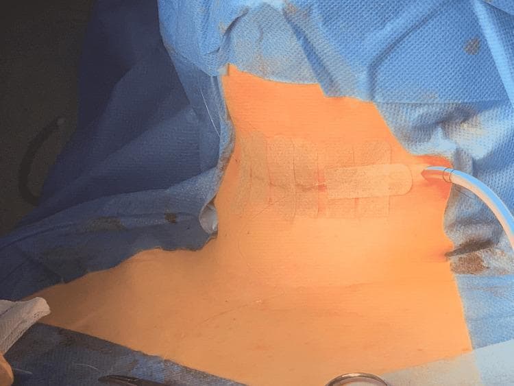 This clinical photograph shows a post-operative surgical site on the anterior neck, consistent with a completed total thyroidectomy and Sistrunk procedure. The primary incision is located in the lower anterior neck and is closed with medical adhesive strips (Steri-Strips) applied transversely across the horizontal wound line. A 15mm Blake aspirative drain is visible, exiting the lateral aspect of the surgical site to facilitate drainage and prevent hematoma formation. The drain is secured with additional adhesive dressing. The surgical field is surrounded by blue sterile drapes, exposing the area from the lower mandible to the clavicular region. The image demonstrates standard post-operative management of a thyroid surgery site, including primary skin closure techniques and active suction drainage. This visual is relevant for medical education concerning head and neck surgery, specifically thyroidectomy and thyroglossal duct cyst management.