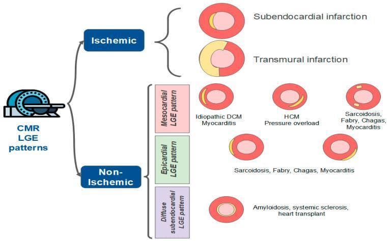A medical educational diagram illustrating late gadolinium enhancement (LGE) patterns observed in Cardiac Magnetic Resonance (CMR) imaging to differentiate between ischemic and non-ischemic myocardial injury. The diagram uses cross-sectional circular representations of the left ventricle, where red indicates healthy myocardium and yellow represents LGE/scar tissue. Ischemic patterns are categorized into subendocardial infarction (limited to the inner layer) and transmural infarction (extending through the full wall thickness). Non-ischemic patterns are subdivided into three categories: 1) Mesocardial LGE, associated with idiopathic dilated cardiomyopathy (DCM), myocarditis, hypertrophic cardiomyopathy (HCM), and pressure overload; 2) Epicardial LGE, found in sarcoidosis, Fabry disease, Chagas disease, and myocarditis; and 3) Diffuse subendocardial LGE, characteristic of amyloidosis, systemic sclerosis, and heart transplant-related injury. The graphic provides a diagnostic pathway for clinical radiology and cardiology to identify specific cardiomyopathies based on the anatomical distribution of gadolinium contrast.