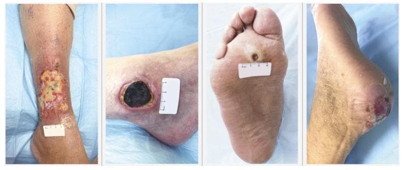 This clinical photograph comparison presents four distinct types of chronic lower extremity wounds, facilitating differential diagnosis in wound care and dermatology. From left to right, the panel demonstrates: 1) Venous Leg Ulcer: A large, irregularly shaped wound on the gaiter area of the lower leg, characterized by a shallow bed with fibrinous slough, granulation tissue, and periwound erythema suggestive of chronic venous insufficiency. 2) Arterial Leg Ulcer: A deeper, more circumscribed wound on the lateral ankle/foot with a dark, necrotic eschar bed and defined borders, indicating severe ischemia. 3) Neuropathic Diabetic Foot Ulcer: Located on the plantar surface (pressure point) of the foot, showing a 'punched-out' circular appearance with a calloused hyperkeratotic rim typical of diabetic neuropathy. 4) Pressure Ulcer: Situated on the posterior heel, displaying deep reddish-purple tissue discoloration and skin breakdown consistent with Stage 2 or deep tissue injury due to prolonged pressure. These images serve as a teaching tool for medical professionals to recognize varied wound etiologies based on anatomical location, wound bed morphology, and periwound skin changes.