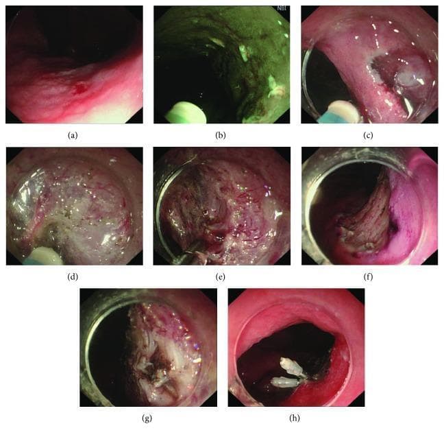 A series of eight endoscopic clinical photographs (a-h) illustrating the step-by-step Endoscopic Submucosal Dissection (ESD) procedure in the gastrointestinal tract. (a) Displays the initial gastric or esophageal lesion under white light endoscopy, characterized by mucosal irregularity and erythema. (b) Shows Narrow Band Imaging (NBI) used to identify and mark the lateral margins of the lesion. (c) Visualizes the circumferential mucosal incision. (d) Demonstrates active submucosal dissection using an electrosurgical knife to separate the lesion from the deeper muscular layer. (e) Shows intraprocedural hemostasis of a bleeding vessel using hot biopsy forceps. (f) Displays the post-resection artificial ulcer base after complete en bloc removal. (g) Identifies an intraprocedural complication involving visible damage to the muscularis propria layer. (h) Illustrates the therapeutic management of the complication, where mechanical endoscopic clips are used to close the muscularis propria defect to prevent luminal perforation. This series serves as an educational resource for gastroenterology trainees to understand ESD stages, instrument usage, and complication management.
