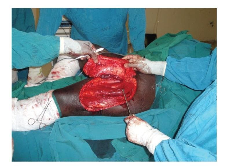 This clinical intraoperative photograph documents the elevation of a pedicled anterolateral thigh (ALT) flap during a reconstructive surgical procedure. The image depicts a large, rectangular fasciocutaneous flap that has been meticulously raised in a subfascial plane, exposing the underlying vastus lateralis and rectus femoris muscles of the donor thigh. The flap's undersurface reveals a highly vascularized appearance with visible subcutaneous fat and fascial tissue, maintained by a central perforating vessel. Surgical personnel in sterile green scrubs and gloves are seen manipulating the flap with both hands and instruments, such as a surgical dissector or retractor, to assess mobility and pedicle length. The surgical field is surrounded by green drapes, and peripheral instruments including hemostats are visible. This visual serves as an educational example of plastic and reconstructive surgery techniques, specifically illustrating the harvest of a locoregional flap for the management of extensive soft tissue defects or contractures.