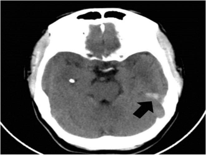 This diagnostic image is an axial non-contrast computed tomography (CT) scan of the brain, a key modality for evaluating neuroanatomical pathology. The scan shows a cross-section of the cerebral hemispheres, including the brain parenchyma, ventricular spaces, and the hyperdense skull vault. A prominent black arrow points to a specific abnormality in the posterior cerebral white matter: a linear, slightly hypoattenuating feature identified as a radial migration line. This finding is a characteristic neuroradiological sign of Tuberous Sclerosis Complex (TSC), representing disordered neuronal migration from the periventricular germinal matrix to the cortex. Additionally, small hyperdense (calcified) foci may be observed elsewhere in the parenchyma, consistent with subependymal nodules or cortical tubers. This visual is intended for medical education regarding the CNS manifestations of phakomatoses, specifically highlighting how CT can identify white matter dysplasias and migration defects when MRI is unavailable.