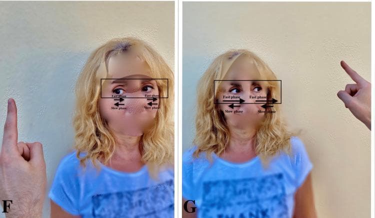 Clinical photograph consisting of two side-by-side images (labeled F and G) demonstrating the assessment of vestibular nystagmus in a patient with acute vestibular loss. In panel F, the examiner's finger is positioned to the patient's left; directional arrows indicate a nystagmus with a slow phase drifting toward the patient's right (the pathologic side) and a fast corrective phase toward the left (the healthy side). In panel G, the examiner's finger moves to the patient's right; annotations illustrate that the nystagmus intensity increases when looking in the direction of the fast phase, consistent with Alexander's Law. This visual educational tool demonstrates the HINTS (Head Impulse, Nystagmus, Test of Skew) examination component used to differentiate peripheral vestibular neuritis from central causes of vertigo, emphasizing that peripheral nystagmus typically has a unidirectional fast phase and follows a specific pattern of slow-phase drift toward the affected ear.