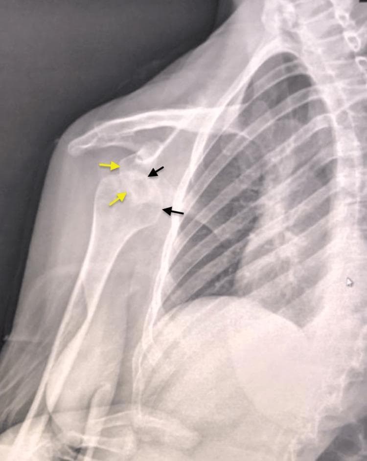 This diagnostic image is a preoperative anteroposterior (AP) X-ray of the right shoulder in a 30-year-old patient. The radiograph demonstrates a significant anterior and medial dislocation of the glenohumeral joint. Key anatomical landmarks are highlighted: yellow arrows point to the empty glenoid cavity of the scapula, while black arrows indicate the displaced humeral head. The humeral head is positioned medially and slightly inferiorly to the glenoid fossa, resting in a subcoracoid position. There is a complete loss of articular congruence between the humeral head and the glenoid. This chronic presentation (three months post-injury) highlights the typical radiological appearance of a neglected shoulder dislocation. The image serves as an educational example for orthopedic trauma and radiology, illustrating joint disruption, displacement patterns in anterior shoulder instability, and the visual assessment of glenohumeral alignment.