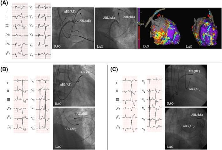 Educational composite image detailing three clinical cases (A, B, C) of bipolar radiofrequency catheter ablation (RFCA) for refractory ventricular premature complexes (VPCs). Each case includes a 12-lead electrocardiogram (ECG) and fluoroscopic images in Right Anterior Oblique (RAO) and Left Anterior Oblique (LAO) views. Case A additionally includes 3D electroanatomical mapping (EnSite) of the left ventricle and coronary sinus. The ECGs demonstrate different morphologies of VPCs, including Right Bundle Branch Block (RBBB) and Left Bundle Branch Block (LBBB) patterns with inferior axes. The fluoroscopic views depict catheter positioning for bipolar ablation, identifying the active electrode (ABL-AE) placed in the left ventricular endocardium and the return electrode (ABL-RE) positioned within the great cardiac vein (GCV) or anterior interventricular vein. The 3D maps in Case A show color-coded voltage/activation data with red tags marking bipolar ablation sites and blue tags marking unipolar sites. This material illustrates the technical approach to targeting intramural or epicardial substrates using a bipolar circuit between the endocardium and the coronary venous system.