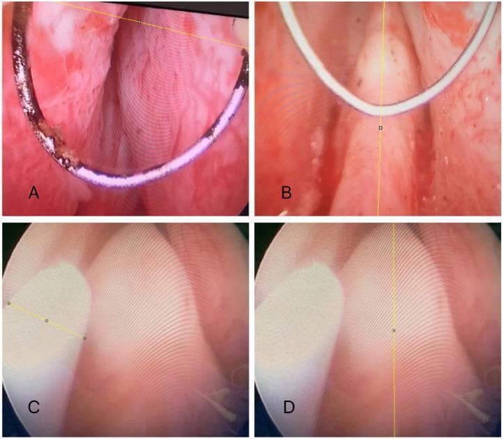 A set of four clinical endoscopic images (A-D) demonstrating the standardized measurement of the verumontanum (seminal colliculus) within the prostatic urethra using continuous-flow resectoscopy. Images A and B depict the use of a bipolar resectoscopic loop as a calibrated reference. In A, a yellow line measures the transverse distance between the loop's ends, while in B, a vertical yellow line measures the longitudinal diameter of the verumontanum. Images C and D show the control group methodology: C utilizes the known diameter of a ureteral catheter as a measurement scale, and D illustrates the resulting longitudinal diameter verification using ImageJ software. The images highlight anatomical variations in the verumontanum, which is a critical surgical landmark during transurethral resection of the prostate (TURP) to prevent damage to the external urinary sphincter. Key visible structures include the urethral crest and the prostatic utricle located on the apex of the colliculus. This educational content illustrates urological morphometric techniques used to assess prostatic changes related to age, BMI, or 5-alpha-reductase inhibitor therapy.