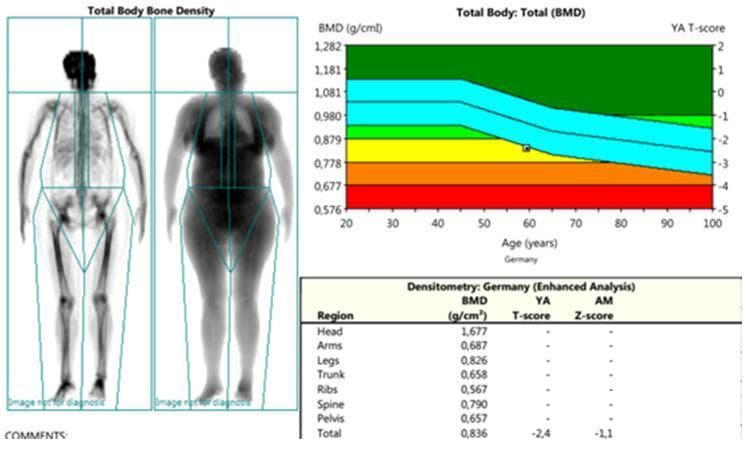 A multi-panel medical diagnostic image showing a Dual-energy X-ray Absorptiometry (DXA) total body composition and bone mineral density (BMD) analysis. The left panel displays two whole-body scans in posterior projection: a skeletal rendering and a soft tissue attenuation map, with cyan-colored region-of-interest (ROI) boxes defining segments for head, trunk, arms, legs, pelvis, and spine. The top-right panel features a scatter plot graph titled 'Total Body: Total (BMD)' comparing the patient's BMD (g/cm²) against age-matched reference data for Germany. The graph uses a color-coded T-score scale: green (normal), yellow (osteopenia), and orange/red (osteoporosis), with the patient's data point positioned at approximately age 60 in the yellow zone. The bottom-right panel contains a 'Densitometry: Germany (Enhanced Analysis)' table, providing regional BMD values. The total body BMD is recorded as 0.836 g/cm², with a corresponding T-score of -2.4 and a Z-score of -1.1, indicating low bone mass (osteopenia) bordering on osteoporosis. This clinical image is typical for metabolic bone disease assessment and fracture risk stratification in geriatric or rheumatological populations.
