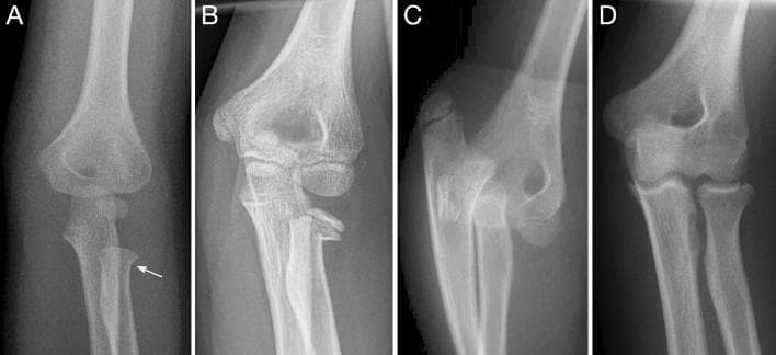 This composite diagnostic image features four anteroposterior and lateral X-ray radiographs (A–D) demonstrating a spectrum of proximal radius fractures in pediatric and adolescent patients. Panel A shows a stable buckle fracture of the radial neck in a 4-year-old, characterized by a focal cortical bulge (indicated by an arrow) with preserved alignment of the radial head and capitellum. Panel B illustrates a Salter-Harris II physeal fracture of the radial neck with moderate lateral displacement of the epiphysis. Panel C depicts a severe, completely displaced metaphyseal radial neck fracture associated with elbow dislocation in a 12-year-old; the radial head is entirely dissociated from both the humeral capitellum and the radial shaft, indicating high risk for avascular necrosis. Panel D displays an intraarticular radial head fracture in a 15-year-old adolescent with closed physes, representing an adult-pattern injury. This series illustrates various injury mechanisms, from stable torus-type fractures to complex articular disruptions and total dislocations, serving as an educational comparison of fracture stability and clinical prognosis in pediatric orthopedics.
