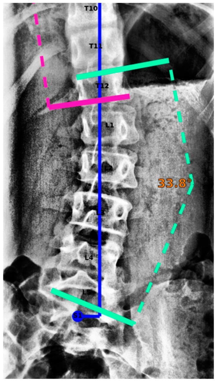 Anteroposterior (AP) X-ray radiograph of the thoracolumbar spine demonstrating a scoliotic curve with superimposed digital measurement aids. The image shows the spinal segment from T10 to S1, with each vertebral body explicitly labeled. A central blue vertical line indicates the coronal midline. Green solid lines are placed at the superior endplate of T11 and the inferior endplate of L5 to define the vertebrae for Cobb angle calculation. A dashed green line traces the lateral spinal curvature on the right side (dextroscoliosis), with a calculated Cobb angle of 33.8 degrees. Additional pink solid and dashed lines provide further alignment references at the T12 level. The image serves as a clinical evaluation of spinal deformity and demonstrates a potential technical outlier where the inferior endplate marker (green line) shows slight misalignment with the S1/L5 junction, highlighting the importance of precise vertebral endplate identification in automated software for scoliosis assessment.