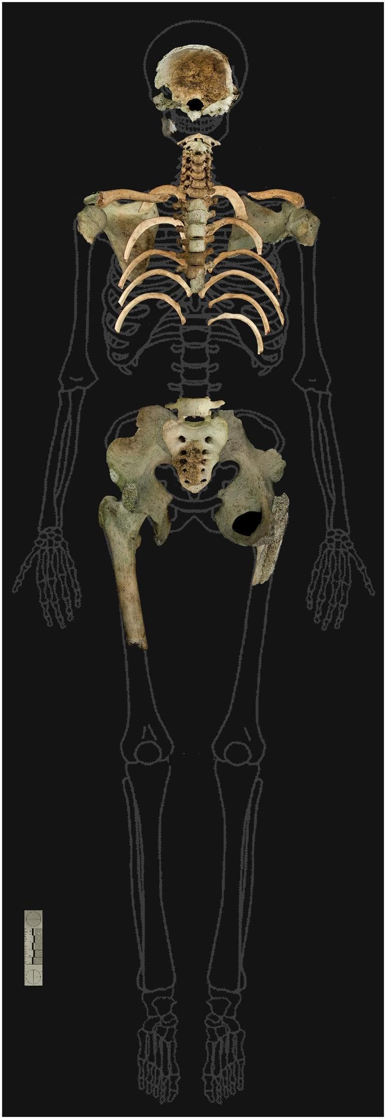 This forensic anatomical diagram displays skeletal remains overlaid on a human body outline to indicate the presence and condition of recovered bones. The image depicts a partially complete skeleton exhibiting significant thermal destruction and weathering. Key visible elements include the cranial vault (skull fragments), several cervical and thoracic vertebrae, clavicles, a partial rib cage, and a nearly complete pelvis with the sacrum. A single right femur is present, showing a distal fracture. The bones display distinctive brownish and blackened discoloration, characteristic of environmental exposure and fire damage (thermal destruction). Anatomically, the remains are arranged in a supine position, highlighting the absence of the upper and lower extremities, including the hands, feet, and most of the long bones. This visual serves as a forensic tool for documenting skeletal representation, estimating biological profile (male, approximately 18-25 years), and reconstructing taphonomic events such as burning in a forest environment.