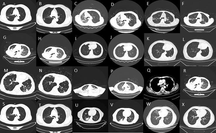 This diagnostic image consists of a 24-panel mosaic (labeled A–X) of axial chest CT scans demonstrating various pulmonary manifestations of Non-Tuberculous Mycobacteria (NTM) infections. The collection illustrates a spectrum of pathological patterns including small pulmonary nodules (prominent in A, B, S, T), patchy ground-glass opacities (E, F, M, W), and dense lobar or segmental consolidation (C, D). Some sections (G, H) show evidence of reduced lung volume and structural distortion, while others (I, J, K, L, R, V) demonstrate post-treatment intervals with relative clearing of parenchymal disease and more distinct bronchovascular markings. The images provide a comparison of disease morphology across different NTM species, such as Mycobacterium avium complex and M. abscessus. Educational focus is placed on recognizing the radiologic hallmarks of chronic mycobacterial lung disease, monitoring treatment response, and identifying the heterogeneity of infectious presentations in different patients.
