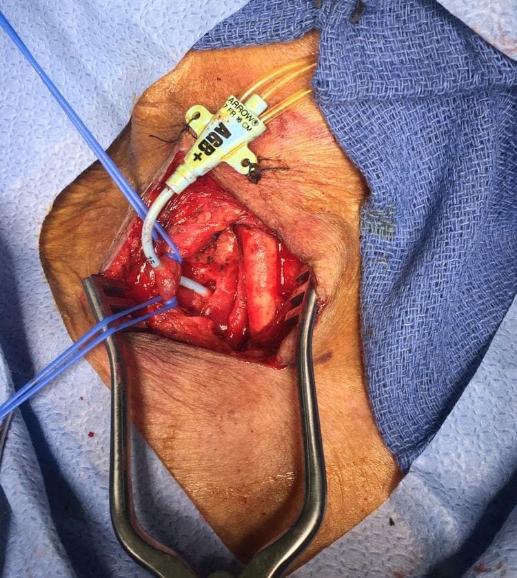 This clinical photograph captures an intraoperative view of a surgical neck exploration performed to address a malpositioned central venous catheter. The image shows a dissected right-sided surgical field with the internal jugular vein (IJV) retracted and controlled using blue vessel loops. A white multi-lumen central line (labeled 'ARROW 7 FR') is visibly traversing through both walls of the IJV. The catheter then tracks deeper into the anatomical space, posterior to the clavicular region, where it is shown piercing the superior aspect of the right subclavian artery. Self-retaining retractors provide exposure of the vascular structures and surrounding soft tissue. This visual serves as a critical educational example of a procedural complication: inadvertent arterial cannulation and through-and-through venous injury during central line placement. It illustrates the complex anatomical relationship between the internal jugular vein and the underlying subclavian artery in the root of the neck.
