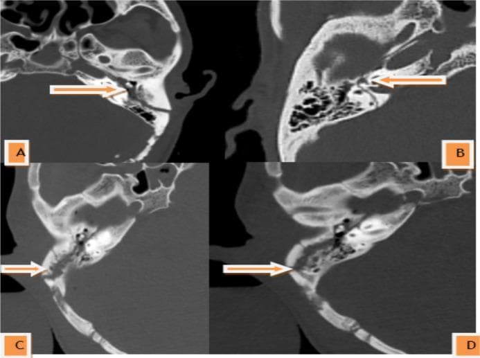 This composite diagnostic image displays four axial non-contrast CT scans of the head in a bone window, specifically illustrating the traditional classification of temporal bone fractures. Image A demonstrates a longitudinal fracture, with the fracture line (indicated by an arrow) running parallel to the long axis of the petrous pyramid, typically associated with otic capsule-sparing trauma and ossicular chain disruption. Image B shows a transverse fracture, where the fracture line runs perpendicular to the long axis of the temporal bone, often involving the otic capsule and increasing the risk of sensorineural hearing loss or facial nerve injury. Images C and D illustrate a mixed fracture pattern, characterized by complex, multi-directional, and branching fracture lines that combine features of both longitudinal and transverse types. The series serves as an educational tool for identifying radiological trauma patterns in the skull base and temporal bone, emphasizing the orientation of fracture lines relative to anatomical landmarks like the petrous ridge and inner ear structures.