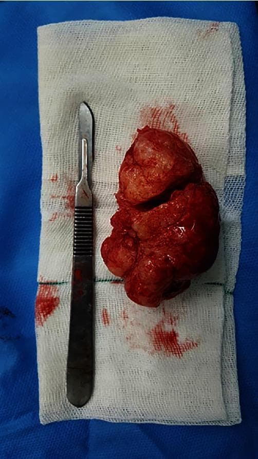 This clinical photograph displays a gross specimen of an enucleated lesion, likely a central ossifying fibroma, following surgical resection from the mandible. The specimen is a large, solid mass with a reddish-brown, hemorrhagic appearance and a multinodular, lobulated surface. It exhibits an irregular shape with areas of indentation and a moist, glistening texture. The lesion is placed on a sterile white surgical gauze pad, which shows minor blood staining. For scale and context, a stainless steel surgical scalpel with a curved blade and ribbed handle is positioned parallel to the specimen. This image illustrates the macroscopic features of a benign but expansive odontogenic tumor after successful enucleation and curettage, common in oral and maxillofacial surgery. The educational focus is on the gross morphology of resected jaw tumors and the clinical results of conservative surgical management for benign osseous lesions.