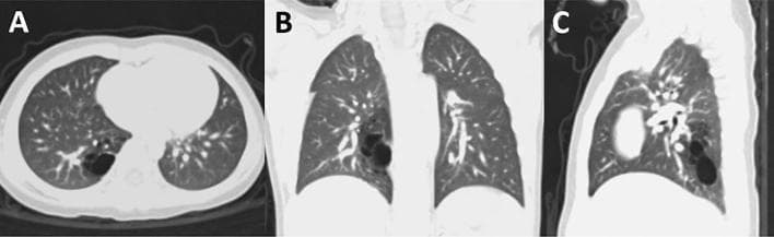 This diagnostic image consists of three chest CT scan views (A: axial, B: coronal, C: sagittal) in a lung window, demonstrating a Congenital Pulmonary Airway Malformation (CPAM). The lesion is characterized by a focal area of well-defined, air-filled cystic spaces with decreased attenuation (radiolucency), localized specifically to the posterior basal segment (S10) of the right lower lobe. The axial view (A) shows the posterior positioning within the right lung field. The coronal (B) and sagittal (C) views further delineate the inferior-superior extent of the malformation near the diaphragmatic surface. The surrounding lung parenchyma and pulmonary vasculature appear normal, with no evidence of significant mediastinal shift, mass effect, or distortion of adjacent anatomical structures. This visual representation is a classic example of a localized Type 1 or Type 2 CPAM, utilized in pediatric radiology and thoracic surgery education to illustrate lung bud developmental anomalies and surgical planning for segmentectomy.