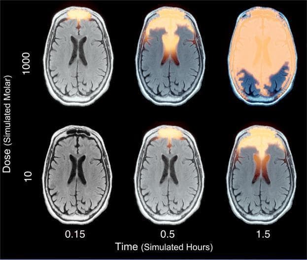 This Comparison Chart displays a series of six axial brain MRI slices illustrating a simulation of intranasal drug diffusion. The images are organized in a 2x3 grid, comparing two simulated molar doses (10e3 and 1000e3) across three simulated time points (0.15, 0.5, and 1.5 hours). Drug concentration is represented by an orange-to-yellow heat map overlay. At the lower dose (bottom row), drug progression is slow, appearing only in the anterior frontal regions by 0.5 hours and reaching approximately the mid-axial plane by 1.5 hours. At the higher dose (top row), diffusion is significantly accelerated: the drug is visible in the anterior brain at 0.15 hours and achieves near-complete parenchymal saturation by 1.5 hours. The simulation demonstrates how anatomical structures and tissue density—inferred from MRI grayscale intensities—influence diffusion kinetics. White matter and higher-density regions appear to constrain spread, while fluid-filled spaces like ventricles facilitate more rapid distribution. This visualization is used in neuropharmacology research to model the spatiotemporal dynamics of intranasal delivery to the central nervous system.