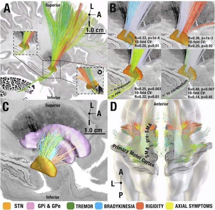 This medical visual consists of four panels (A-D) illustrating deep brain stimulation (DBS) symptom-response tracts in Parkinson’s disease using fiber tractography. The anatomical focus is the subthalamic nucleus (STN, orange) and its functional connectivity. Panels A-C provide medial sagittal views showing a distinct rostrocaudal gradient of symptom-specific fiber pathways passing through the STN: tremor-responsive tracts (green) are most posterior/occipital, followed by bradykinesia (blue), axial symptoms (yellow), and rigidity (red) in the anterior direction. Panel B highlights statistical correlations and cross-validation for each symptom tract, noting connections to the pedunculopontine nucleus (PPN), brainstem, and cerebellum. Panel C illustrates indirect pathway streamlines between the STN and the globus pallidus (GPi/GPe, purple). Panel D shows an axial/superior view of the cortical origins of hyperdirect projections; tremor-associated streamlines originate from the primary motor cortex, while hypokinetic symptoms (bradykinesia, rigidity, axial) correlate with streamlines originating from the supplementary motor area (SMA) and pre-SMA. The figure serves as a neuroanatomical guide for targeting specific Parkinsonian symptoms during neuromodulation.