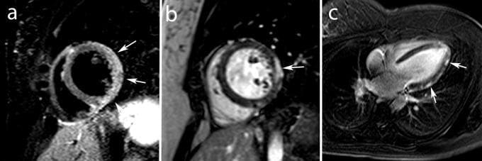 Diagnostic cardiac MRI study illustrating findings consistent with acute myocarditis in a young adult. Panel A presents a mid-ventricular short-axis view using T2-weighted Short Tau Inversion Recovery (STIR) imaging, which demonstrates high signal intensity (hyperintensity) in the lateral myocardium, indicated by arrows, representing myocardial edema. Panel B shows a contrast-enhanced (ce-MRI) mid-ventricular short-axis view, and Panel C shows a vertical long-axis view. Both contrast-enhanced images reveal characteristic late gadolinium enhancement (LGE) with a subepicardial distribution along the lateral wall (white arrows). The absence of subendocardial involvement helps differentiate this inflammatory pattern from ischemic injury. These imaging hallmarks—edema on T2-weighted sequences and subepicardial LGE—are critical diagnostic criteria for myocarditis in the clinical context of acute chest pain.