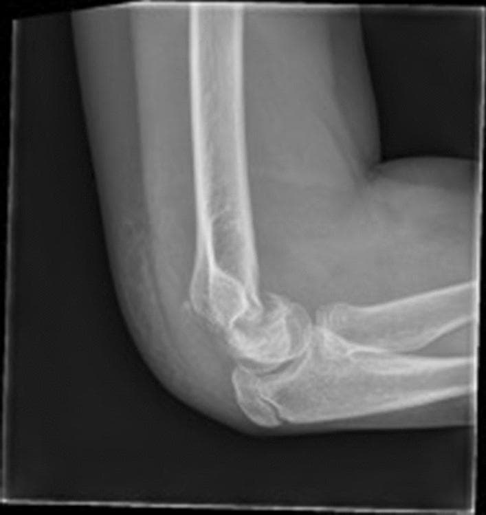 A lateral view X-ray of a pediatric elbow demonstrating a flexion-type supracondylar fracture of the humerus. The diagnostic image shows a complete transverse fracture line across the distal humerus in the supracondylar region. Key visual findings include anterior angulation and anterior displacement of the distal humeral fragment relative to the humeral shaft. Specifically, the anterior humeral line (AHL) is seen passing posterior to the capitellum, a classic radiological sign of a flexion-pattern injury. This indicates failure of the posterior cortex with the anterior periosteum potentially acting as a hinge. The joint space and proximal radius and ulna are visible, providing anatomical context for the elbow joint's sagittal alignment. This image serves as a clinical teaching aid for orthopedic traumatology, highlighting the less common supracondylar fracture variant often associated with direct trauma to the posterior elbow and a higher risk of ulnar nerve injury compared to extension-type fractures.
