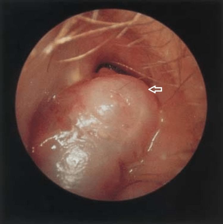 This clinical photograph, obtained through microscopic otoscopy, displays the right external auditory canal (EAC) of a patient. The central focus is a prominent, fleshy soft-tissue mass, indicated by a white arrow. The mass is pale pink to tan in color, with a smooth, glistening surface and a lobulated, irregular morphology. It occupies a significant portion of the canal lumen, originating from the posterosuperior wall. Fine hair follicles characteristic of the lateral EAC are visible in the foreground. This finding is clinically significant for evaluating chronic ear pathologies, such as aural polyps or extensive cholesteatoma, particularly when associated with chronic suppurative otitis media (CSOM). The image demonstrates how such a mass can obscure the view of the tympanic membrane and deeper middle ear structures. It serves as an educational example of otoscopic signs requiring further diagnostic imaging (CT or MRI) to assess for intracranial complications like mastoiditis or cerebral abscess.