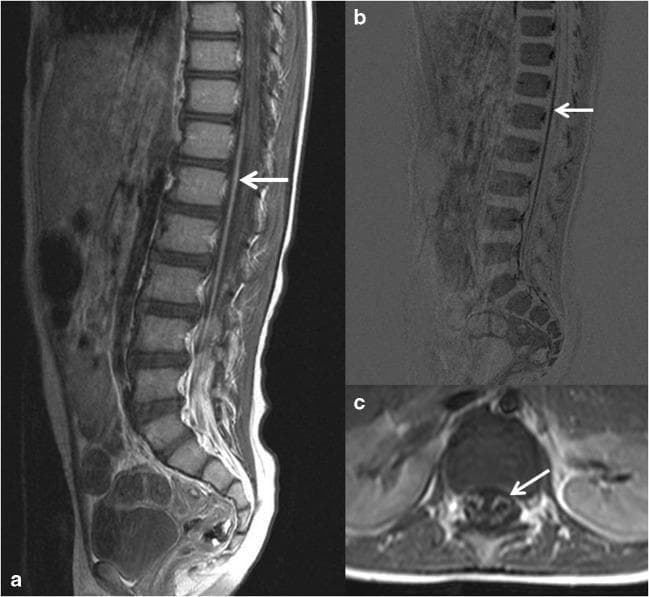 This composite diagnostic image features Magnetic Resonance Imaging (MRI) of the thoracolumbar spinal cord in a pediatric patient diagnosed with Guillain-Barré syndrome. Panel (a) is a sagittal T1-weighted contrast-enhanced MRI showing prominent enhancement of the anterior caudal nerve roots, which appear hyperintense (bright) against the relatively darker spinal cord and cerebrospinal fluid. Panel (b) presents a digital subtraction image of the sagittal T1 sequence, which minimizes background anatomical signal to highlight the contrast uptake in the ventral roots (indicated by arrows). Panel (c) is a transverse T1-weighted contrast-enhanced section demonstrating localized enhancement specifically within the anterior motor nerve roots. These radiological findings illustrate the classic breakdown of the blood-nerve barrier and inflammatory changes characteristic of acute inflammatory demyelinating polyradiculoneuropathy. Key educational features include the anatomical localization of root involvement and the utility of contrast-enhanced sequences and subtraction techniques in differentiating inflammatory neuropathies from other causes of acute flaccid paralysis.