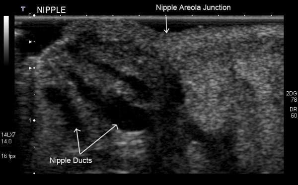 This diagnostic image is a high-resolution grayscale ultrasound scan of a lactating human breast, specifically focusing on the nipple-areola complex. The anatomy is labeled, showing the nipple and the nipple-areola junction. The surrounding nipple tissue exhibits a heterogeneous, primarily echogenic (bright) texture. Within the substance of the nipple, multiple milk ducts are clearly visualized as distinct hypoechoic (dark), tubular, and elongated structures. These ducts extend from the deeper mammary parenchyma toward the nipple surface. The educational focus of this image is the sonographic visualization of normal ductal anatomy during lactation, demonstrating how physiological distension allows these structures to be identified. The image highlights key diagnostic features such as the hypoechoic nature of fluid-filled ducts relative to the echogenic fibrous and glandular stromal tissue, which is clinically relevant for assessing ductal patency or identifying obstructive conditions like blocked ducts.