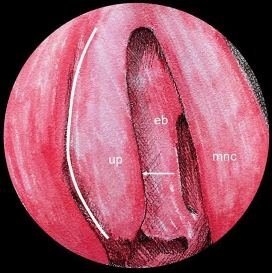 This medical illustration depicts the endoscopic anatomy of the right nasal cavity lateral wall, specifically focusing on the ostiomeatal complex (OMC). The diagram uses a color-shaded style to differentiate key surgical landmarks. Centrally, the ethmoidal bulla (eb) is shown as a prominent pneumatized structure. Anterior to it lies the uncinate process (up), a thin, hook-like bone. The space between the uncinate process and the ethmoidal bulla, known as the semilunar hiatus, is indicated by a horizontal white arrow. Medially, the middle nasal concha (mnc), or middle turbinate, is visible. For surgical context, a curved white line is superimposed on the lateral aspect of the uncinate process to mark the approximate limit for an uncinectomy, a primary step in functional endoscopic sinus surgery (FESS) to access the ethmoidal infundibulum and maxillary ostium. This educational visual is designed to assist in identifying anatomical relationships necessary for safe navigation during paranasal sinus procedures.