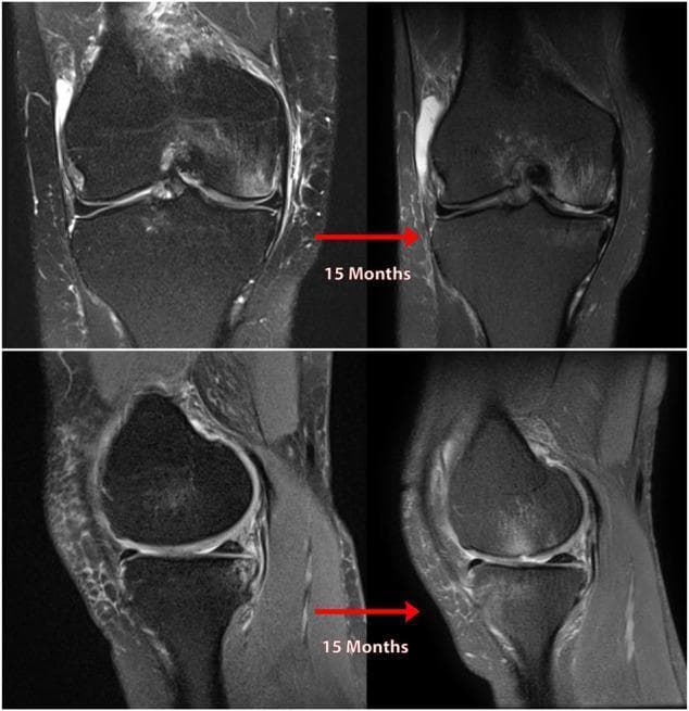 This diagnostic imaging set consists of T2-weighted fat-saturated MR images of the knee in coronal and sagittal planes, illustrating the 15-month progression of post-traumatic osteoarthritis following a neglected posterior medial meniscus root tear (PMMRT). The coronal series shows progressive medial compartment joint space narrowing and increasing medial meniscal extrusion. The sagittal series demonstrates progressive degradation of the meniscal body, thinning of the articular cartilage, and development of subchondral bone marrow edema. Significant joint effusion is visible as hyperintense signal within the suprapatellar bursa and joint space. These images serve as an educational clinical example of how loss of meniscal root integrity leads to altered biomechanical loading, rapid chondromalacia, and secondary degenerative joint disease in an otherwise stable knee.