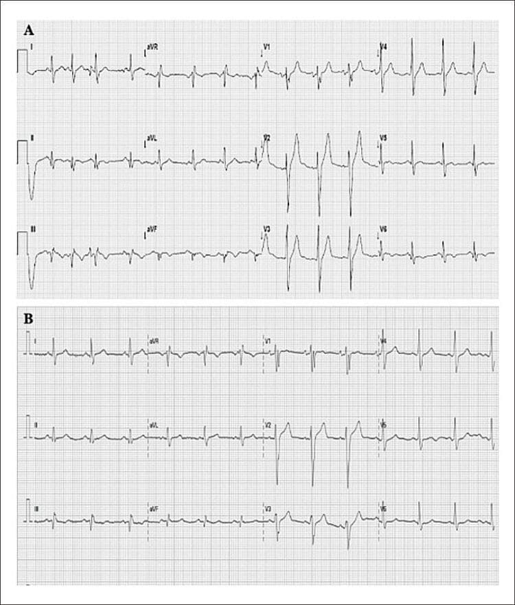 This diagnostic image displays two 12-lead electrocardiograms (ECGs) labeled Panel A and Panel B, presented on standard grid paper for clinical comparison. Panel A shows a 12-lead ECG demonstrating sinus rhythm with normal P-wave morphology. The QRS complexes exhibit nonspecific intraventricular conduction disturbances, characterized by widened or slurred morphologies in certain leads, notably the precordial leads V1-V6. Panel B shows a subsequent ECG from the same patient. Comparison between the two panels reveals subtle variations in waveform amplitude and ST-segment baseline, though both lack overt ST-segment elevation. The precordial leads (V1-V6) show a typical progression of R-wave amplitude, while lead aVR shows the expected global inversion of P, QRS, and T waves. This comparison is used in cardiology to monitor electrical changes during acute coronary syndromes, such as Non-ST Segment Elevation Myocardial Infarction (NSTEMI), where conduction disturbances may be present despite the absence of classic ST-elevation.