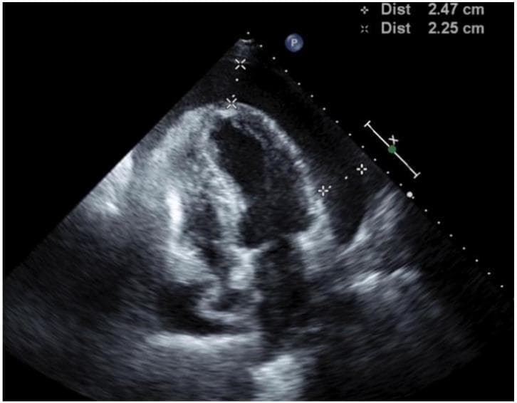 Diagnostic Image: This transthoracic echocardiogram (TTE) in a four-chamber view illustrates a large, circumferential pericardial effusion, visible as a prominent echo-free (anechoic) space surrounding the myocardium. The maximum depth of the effusion is quantified by calipers measuring 2.47 cm and 2.25 cm. Key hemodynamic findings indicative of cardiac tamponade are present, specifically the inward invagination and diastolic collapse of the right atrium and right ventricle. These visual signs suggest that intrapericardial pressure exceeds the filling pressures of the right-sided heart chambers. The image provides critical diagnostic evidence for urgent clinical intervention, such as pericardiocentesis. The educational focus is on identifying sonographic markers of tamponade physiology in the context of oncological complications, such as metastatic adenocarcinoma of the lung.