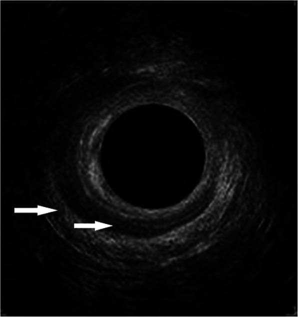 This diagnostic image is an axial cross-section from an endoanal ultrasonography (EAUS) focusing on the mid anal canal. The image demonstrates the characteristic concentric anatomy of the anal sphincter complex with two distinct muscular layers indicated by white arrows. The external anal sphincter (EAS) is visualized as the peripheral, hyperechoic (brighter) ring. A significant structural defect in the EAS is evident, extending from the 9 o'clock to the 3 o'clock position, characterized by a loss of echoic continuity. Internal to this, the internal anal sphincter (IAS) appears as a darker, hypoechoic ring. The IAS also exhibits a pathological defect, visible from the 11 o'clock to the 4 o'clock position. Such findings are clinically significant in the evaluation of obstetric anal sphincter injuries (OASI) and the assessment of fecal or anal incontinence. The image serves as an educational example of how ultrasound can identify localized muscular disruptions and quantify the extent of sphincter damage using clock-face orientation.
