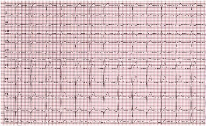 This diagnostic image displays a standard 12-lead electrocardiogram (ECG) recorded on a red millimetric grid at a paper speed of 25 mm/s. The tracing shows a normal sinus rhythm with a ventricular rate of approximately 79 beats per minute. The ECG is organized into 12 labeled horizontal leads: limb leads (I, II, III), augmented limb leads (aVR, aVL, aVF), and precordial chest leads (V1 through V6). Key educational features include a normal P-wave morphology and a consistent PR interval. There is a characteristic R-wave progression visible across the precordial leads; V1 demonstrates a predominantly negative QRS complex with a small r-wave, which progressively transitions to a predominantly positive R-wave by V6. The ST segments are isoelectric, and T-wave morphology appears normal across all leads. This visual serves as a baseline clinical reference for normal cardiac electrical activity in a patient before the onset of symptomatic bradycardia.