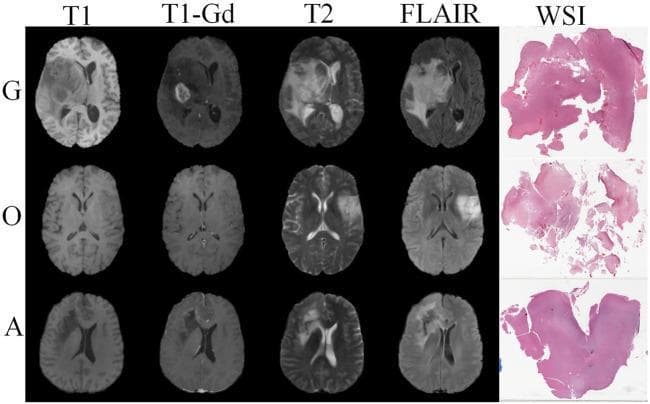 This medical comparison chart displays axial brain MRI sequences and corresponding histopathological whole slide images (WSI) for three glioma subtypes: Glioblastoma (G), Oligodendroglioma (O), and Astrocytoma (A). The MRI modalities include T1-weighted, T1-gadolinium contrasted (T1-Gd), T2-weighted, and Fluid-Attenuated Inversion Recovery (FLAIR). The Glioblastoma row shows a large, heterogeneous mass with significant peripheral enhancement on T1-Gd and extensive hyperintense peritumoral edema on T2 and FLAIR images. The Oligodendroglioma and Astrocytoma rows demonstrate smaller, less infiltrative masses with varying signal intensities. The final column displays Hematoxylin and Eosin (H&E) stained WSI biopsy sections, illustrating the histological differences in tissue architecture and cellularity between the subtypes, such as the more fragmented appearance of the oligodendroglioma sample compared to the more cohesive astrocytoma section. This visual resource is intended for neuroradiology and pathology education, emphasizing the integration of multi-modal imaging and histology for definitive brain tumor classification.