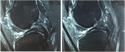 Two sagittal T2-weighted magnetic resonance imaging (MRI) slices of the human knee joint demonstrate a rare anatomical meniscal variant. The diagnostic images show the distal femur, proximal tibia, and the posterior aspect of the knee joint. A prominent feature is the posterior junction and fusion of the medial and lateral meniscal horns. Specifically, fibers from the anterior cruciate ligament (ACL) appear to insert directly into the posterior horn of the lateral meniscus rather than their typical tibial attachment, a condition associated with visible thinning of the primary ACL band. Both the ACL and the posterior cruciate ligament (PCL) are visible as hypointense, dark structures against the hyperintense signal of joint fluid. This imaging is clinically significant for identifying rare congenital variations in meniscal morphology that can predispose patients to mechanical blocking or knee locking symptoms. The visualization highlights the complex relationships between the cruciate ligaments and meniscal attachments within the intra-articular space.
