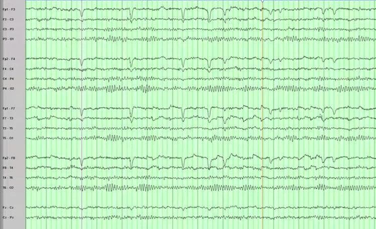 This diagnostic image shows a standard scalp electroencephalogram (EEG) recording from a human subject. The tracing is organized into multiple horizontal channels, with electrode derivations labeled on the left side of the display (e.g., Fp1-F3, F3-C3, C3-P3, P3-O1), representing the 10-20 system in a longitudinal bipolar montage. The recording displays continuous electrical activity of the brain, characterized primarily by high-frequency waves of 8 Hz and higher, consistent with alpha and beta rhythms. The wave morphology is relatively symmetric and regular across the hemispheres, without evident epileptiform discharges, focal slowing, or lateralized periodic discharges. Vertical green grid lines provide a temporal scale for frequency analysis, while vertical deflections in frontal channels (Fp1, Fp2) likely represent physiological artifacts such as eye blinks. This tracing is identified as a normal EEG in the context of a patient presenting with metabolic-induced seizures, serving as an educational example of how systemic conditions like hypoglycemia from an insulinoma can mimic primary epilepsy despite a normal interictal EEG.