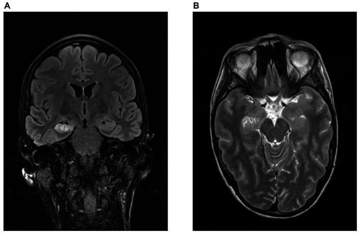 Magnetic Resonance Imaging (MRI) of the brain in a patient with GAD-antibody-associated limbic encephalitis. Panel A displays a coronal FLAIR (Fluid-Attenuated Inversion Recovery) sequence showing marked hyperintensity and swelling in the right hippocampus and mesial temporal lobe. Panel B shows a transversal T2-weighted sequence highlighting increased signal intensity in the right amygdala complex, hippocampus, and nucleus accumbens. These findings are consistent with active inflammation and space-occupying effects in the limbic system, characteristic of autoimmune encephalitis. The images illustrate the typical neuroradiological presentation used to diagnose hippocampal pathology, demonstrating asymmetrical signal changes and morphological swelling compared to the healthy contralateral left side.