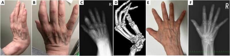 This composite figure displays clinical and multi-modality imaging findings of a patient with Rheumatoid Arthritis (RA) and striatal hand deformity. Panels A and B are clinical photographs showing significant swelling of the proximal interphalangeal (PIP) and metacarpophalangeal (MCP) joints, with a rigid, flexed deformity of the right wrist resembling bony ankylosis. Panel C is a posteroanterior hand radiograph demonstrating periarticular osteopenia, radiocarpal joint space narrowing, and flexion of the index finger distal interphalangeal (DIP) joint. Panel D provides a 3D CT reconstruction that clearly visualizes a dorsal dislocation of the distal ulnar joint and spatial misalignment of the carpal bones without true osseous bridging. Panels E and F show post-treatment clinical and radiographic follow-up, respectively, highlighting a marked reduction in soft tissue swelling of the hand and improved joint alignment and bone density. The collection illustrates the differentiation between fixed dystonic deformities and active inflammatory arthropathy in a rheumatological context, emphasizing the importance of cross-sectional imaging (CT) over 2D radiography for assessing complex joint architecture.