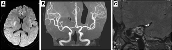 This composite diagnostic image illustrates clinical findings in a patient with a cerebral vascular event. Panel A is an axial MRI Diffusion-Weighted Image (DWI) showing a focal, hyperintense (bright) lesion in the region of the right posterior limb of the internal capsule, consistent with an acute lacunar infarct. Panel B displays a Magnetic Resonance Angiogram (MRA) of the Circle of Willis, which shows no gross occlusion or high-grade stenosis in the major branches, including the middle cerebral arteries (MCA). Panel C is a high-resolution MRI (HR-MRI) focusing on the proximal segment of the right MCA. A white arrow highlights an eccentric, T2-weighted hypointense thickening on the arterial wall, identified as an atherosclerotic plaque. This image series demonstrates how HR-MRI can detect vulnerable or non-stenotic atherosclerotic plaques as an underlying etiology for ischemic stroke when conventional MRA appears normal. The content is suitable for intermediate to advanced neurology and radiology trainees.