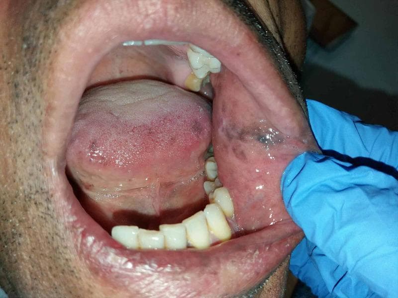 A clinical photograph of the oral cavity of an adult male, demonstrating hallmark signs of Addisonian melanoglossia and mucosal hyperpigmentation. The view is facilitated by a gloved hand retracting the left cheek. Distinctive dark brown to slate-gray macules and confluent patches are visible on the left buccal mucosa, exhibiting irregular borders and varying intensity. Similar hyperpigmented lesions are observed on the lateral and posterior surfaces of the tongue, presenting as mottled, reddish-purple to dark brown areas. The surrounding gingiva and hard palate appear relatively unaffected. The perioral skin also shows signs of generalized darkening. This image illustrates the oral manifestations of primary adrenal insufficiency (Addison's disease), where increased adrenocorticotropic hormone (ACTH) leads to excessive melanin production by melanocytes. This material is useful for medical students and clinicians in identifying dermatological markers of systemic endocrine disorders and adrenal crisis risk assessment.