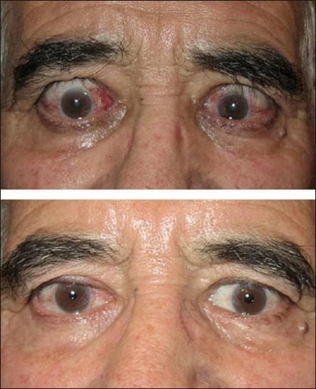 This comparison clinical photograph shows a 62-year-old male with active Graves' ophthalmopathy before and after medical intervention. The top image demonstrates hallmark signs of thyroid eye disease, including bilateral upper eyelid retraction (Dalrymple sign), exophthalmos (proptosis), and significant conjunctival hyperemia. Notably, the patient exhibits conjunctival chemosis and focal redness near the medial canthus of the right eye, accompanied by periorbital edema and increased forehead wrinkling likely due to compensatory frontalis muscle overactivity. The bottom image shows the clinical outcome following steroid treatment and botulinum toxin injection to the upper eyelids. There is a marked reduction in ocular surface inflammation and redness. The eyelid position has significantly improved with reduced scleral show, and the periorbital region appears less edematous with a more relaxed brow position. This visual illustrates the management of ocular manifestations in autoimmune thyroid disease, focusing on the improvement of lid retraction and clinical activity scores (CAS).