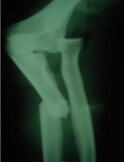 This lateral view X-ray of the elbow and proximal forearm demonstrates a Monteggia fracture-dislocation. Key diagnostic findings include a complete, displaced fracture of the proximal third of the ulnar shaft. Associated with this ulnar injury is an anterior dislocation of the radial head relative to the capitellum of the humerus, consistent with a Bado Type I injury pattern. The alignment of the radiocapitellar line is disrupted, failing to pass through the center of the capitellum. This imaging serves as a classic educational example of the forearm's 'two-bone system' failure, where a displaced fracture of one bone (ulna) necessitates a dislocation or fracture of the second bone (radius or its joints) to accommodate the change in length and mechanical force. Clinical relevance includes the importance of assessing the elbow joint in all isolated-appearing ulnar shaft fractures to prevent missed radial head dislocations.