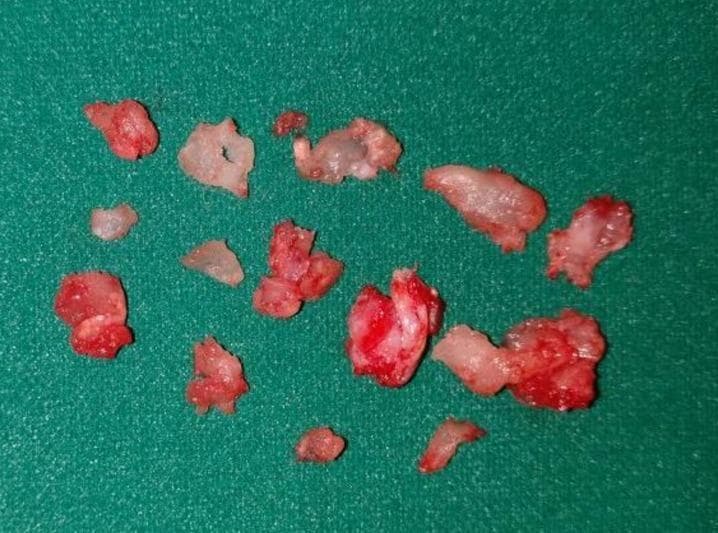 This clinical photograph shows multiple fragments of excised surgical tissue from a canal wall down modified radical mastoidectomy. The specimens, obtained in a piecemeal fashion, are displayed on a green sterile surgical drape. The tissue fragments vary in size and morphology, appearing as irregular, lobulated masses. They exhibit a heterogeneous color profile consisting of fleshy pink and vibrant red areas indicative of vascularization or granulation tissue, interspersed with paler, translucent, and firmer white regions suggestive of fibro-osseous components or calcified stroma. The specimen represents a benign fibro-osseous lesion involving the middle ear and mastoid cavity. This visual serves as an educational example of macroscopic specimen evaluation in otolaryngology and surgical pathology, highlighting the characteristic appearance of tissue removed during ear canal and mastoid surgery for benign neoplasms or chronic inflammatory processes.