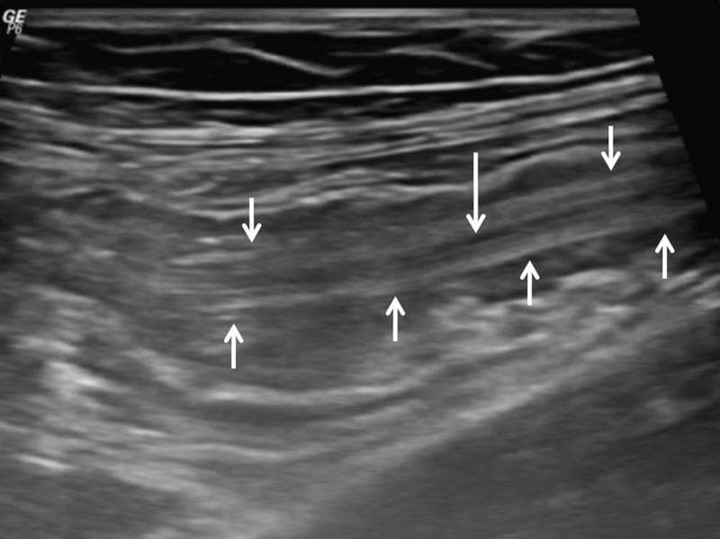 This diagnostic image is an abdominal ultrasound scan in longitudinal view, demonstrating classic sonographic signs of intestinal helminthic infestation, specifically Ascaris lumbricoides. The image reveals multiple tubular, echogenic structures within the intestinal lumen. These structures exhibit a characteristic 'railway tract' appearance, defined by parallel echogenic lines representing the worm's outer wall. A central, longitudinal anechoic line is visible between these walls (indicated by the long white arrow), representing the parasite's digestive tract. Notably, there is an absence of posterior acoustic shadowing, which helps differentiate these soft-bodied parasites from calcified structures or gallstones. The small white arrows highlight the distinct parallel margins of the worms. This imaging finding is pathognomonic for ascariasis in the appropriate clinical context and is essential for diagnosing parasitic causes of bowel obstruction or intussusception. The content is suitable for medical students and radiology residents studying gastrointestinal pathology and tropical medicine.